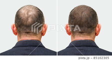 The head of a balding man before and after hair transplant surgery. A man losing his hair has become shaggy. An advertising poster for a hair transplant clinic. Treatment of baldness. The head of a balding man before and after hair transplant surgery. A man losing his hair has become shaggy. An advertising poster for a hair transplant clinic. Treatment of baldness. 85102305
