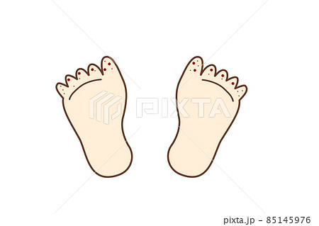 イラスト素材 手足口病になった足の指のイラスト素材