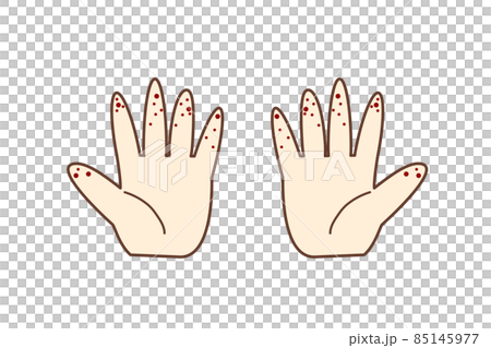 Illustration material: Fingertips of hand with hand-foot-and-mouth disease 85145977
