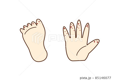 イラスト素材 手足口病になった手の指と足の指のイラスト素材