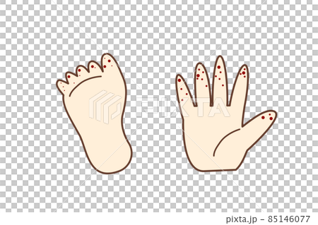 Illustration material: Fingers and toes of hand-foot-and-mouth disease 85146077