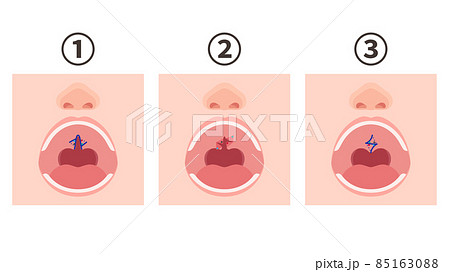 口唇口蓋裂_口蓋裂の手術方法のイラスト_ファーラー法 口唇口蓋裂_口蓋裂の手術方法のイラスト_ファーラー法 85163088
