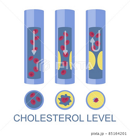 Low, normal, high cholesterol level, vector illustration. High ldl risk factor for heart disease, atherosclerosis. 85164201
