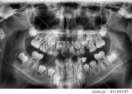 x-ray of the jaw of an 8-year-old child 85166285