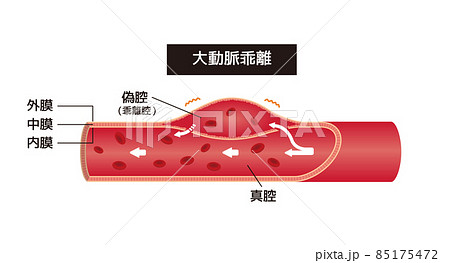 大動脈乖離の症状 / 血管断面図イラスト 85175472