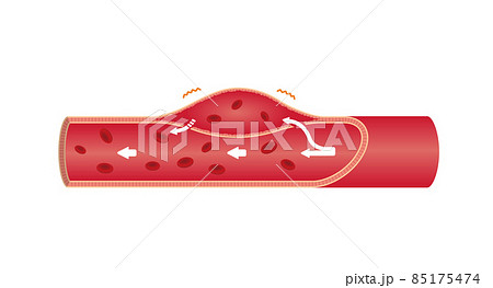 大動脈乖離の症状 / 血管断面図イラスト (文字なし) 大動脈乖離の症状 / 血管断面図イラスト (文字なし) 85175474