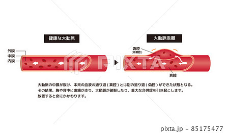 健康な大動脈と大動脈乖離の比較イラスト (解説文つき) 85175477