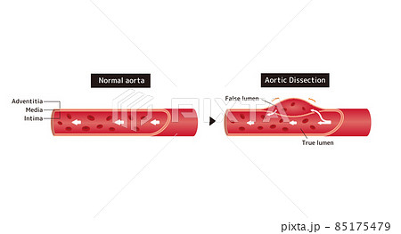 健康な大動脈と大動脈乖離の比較イラスト (英語) 85175479