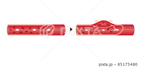 健康な大動脈と大動脈乖離の比較イラスト 文字なし のイラスト素材