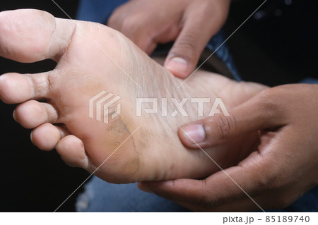 close up of young men dry feet on bed , close up of young men dry feet on bed , 85189740