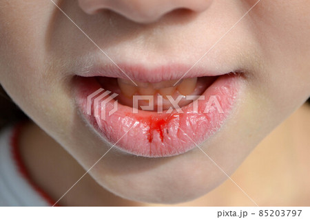 Dry and damaged lips of a girl 85203797