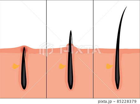 Normal and ingrown hair vector illustration. Skincare problem. 85228379