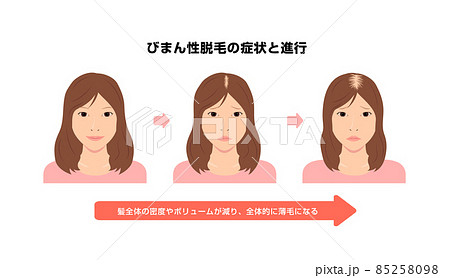 女性のびまん性脱毛症の症状と進行 ベクターイラスト 85258098