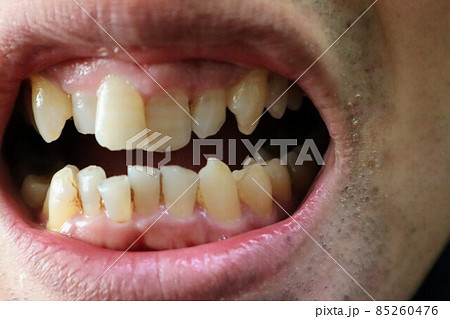 歯並びが悪い歯のクローズアップ 歯並びが悪い歯のクローズアップ 85260476