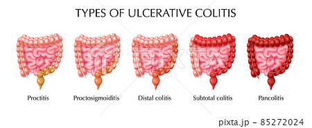 Ulcerative Colitis Types Infographics 85272024