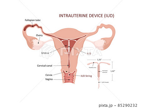 Intrauterine device. Contraceptives method, IUD. Control and protection of pregnancy. Intrauterine device in the uterus Intrauterine device. Contraceptives method, IUD. Control and protection of pregnancy. Intrauterine device in the uterus 85290232