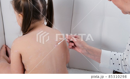 Female being treated with chickenpox rash on little girl's body with atiseptic cream at home. The Female being treated with chickenpox rash on little girl's body with atiseptic cream at home. The 85310298