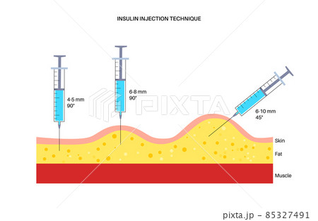 Insulin injection sites Insulin injection sites 85327491