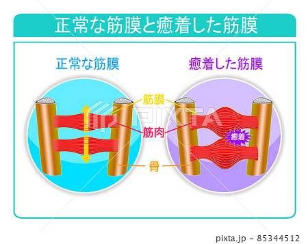 正常な筋膜と癒着した筋膜のイラスト素材