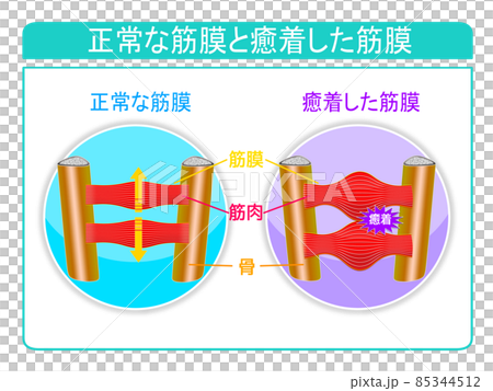 正常な筋膜と癒着した筋膜 85344512