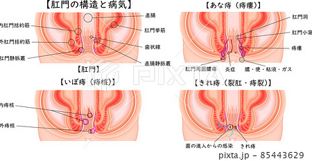 肛門　痔　きれ痔　あな痔　いぼ痔　イラスト　日本語 85443629