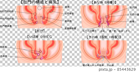 肛門　痔　きれ痔　あな痔　いぼ痔　イラスト　日本語 85443629