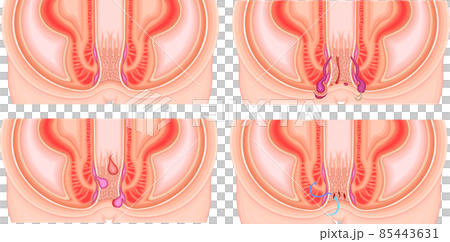 肛裂，肛裂，痔瘡，痔瘡，插圖 85443631