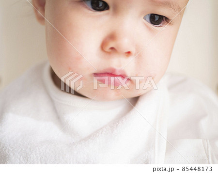 ハーフの赤ちゃんの口元の湿疹　イメージ　 85448173