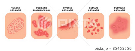 Psoriasis. Allergic eczema types, rashes treatment. Dermatology infectious spots, skin disease. Epidermis infection problems recent vector concept 85455556