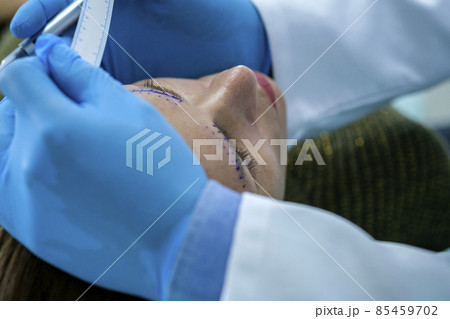 Marking before plastic surgery for eyebrow correction 85459702