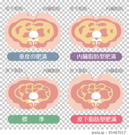肥満のタイプ　皮下脂肪と内臓脂肪 85467017