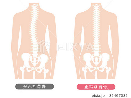 人間の体 正常な背骨と歪んだ背骨のイラスト素材