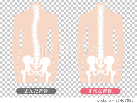人體正常脊柱和脊柱變形 85467085