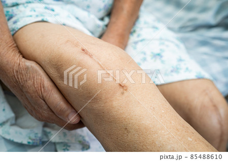 Asian senior or elderly old lady woman patient show her scars surgical total knee joint replacement Suture wound surgery arthroplasty on bed in nursing hospital ward, healthy strong medical concept. Asian senior or elderly old lady woman patient show her scars surgical total knee joint replacement Suture wound surgery arthroplasty on bed in nursing hospital ward, healthy strong medical concept. 85488610