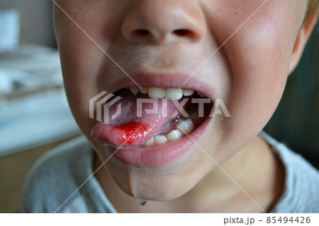 Close-up of lips, tongue, protrusion of blood. Child's bitten tongue. Close-up of lips, tongue, protrusion of blood. Child's bitten tongue. 85494426