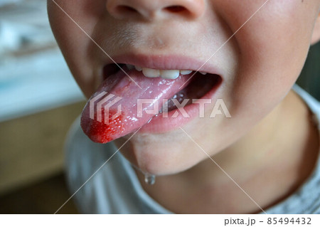Close-up of a metal plate in the mouth on the teeth of a little boy Close-up of a metal plate in the mouth on the teeth of a little boy 85494432