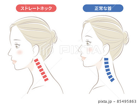 ストレートネックの女性 85495863