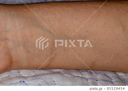 human pulse with allergy spots 85529454