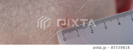 Male neck after laser removal of moles and papillomas closeup 85539818