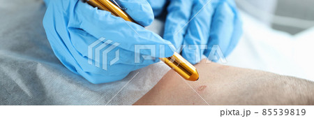 Laser removal of a mole on man neck in beauty salon 85539819