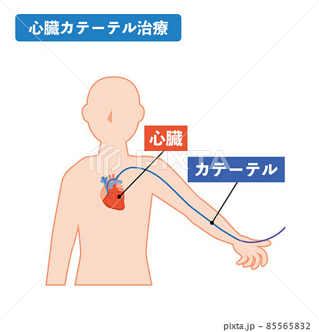 心臓カテーテル治療のイメージ 心臓カテーテル治療のイメージ 85565832