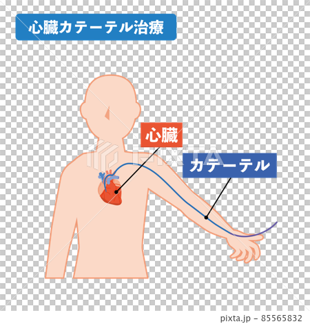 心臓カテーテル治療のイメージ 心臓カテーテル治療のイメージ 85565832
