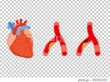 Heart and narrowed blood vessels Heart and narrowed blood vessels 85565833