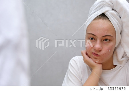 Acne treatment. A teenage girl twisted her face Acne treatment. A teenage girl twisted her face 85573976