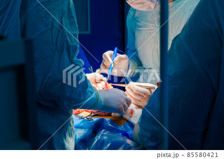 The hands of surgeons in sterile gloves operate with an electrocoagulator. The hands of surgeons in sterile gloves operate with an electrocoagulator. 85580421