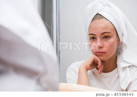 Acne. A sad teenage girl. Problematic skin in adolescents. Acne. A sad teenage girl. Problematic skin in adolescents. 85598543