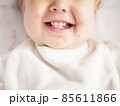 ハーフの赤ちゃんの口元の湿疹　イメージ　 85611866