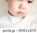 ハーフの赤ちゃんの口元の湿疹　イメージ　 85611870
