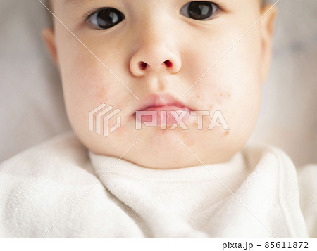 ハーフの赤ちゃんの口元の湿疹　イメージ　 85611872