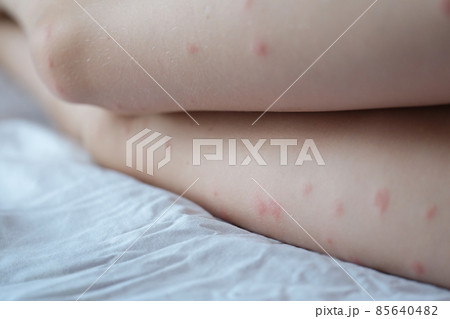 Red rash on the white skin of female legs, pimples 85640482
